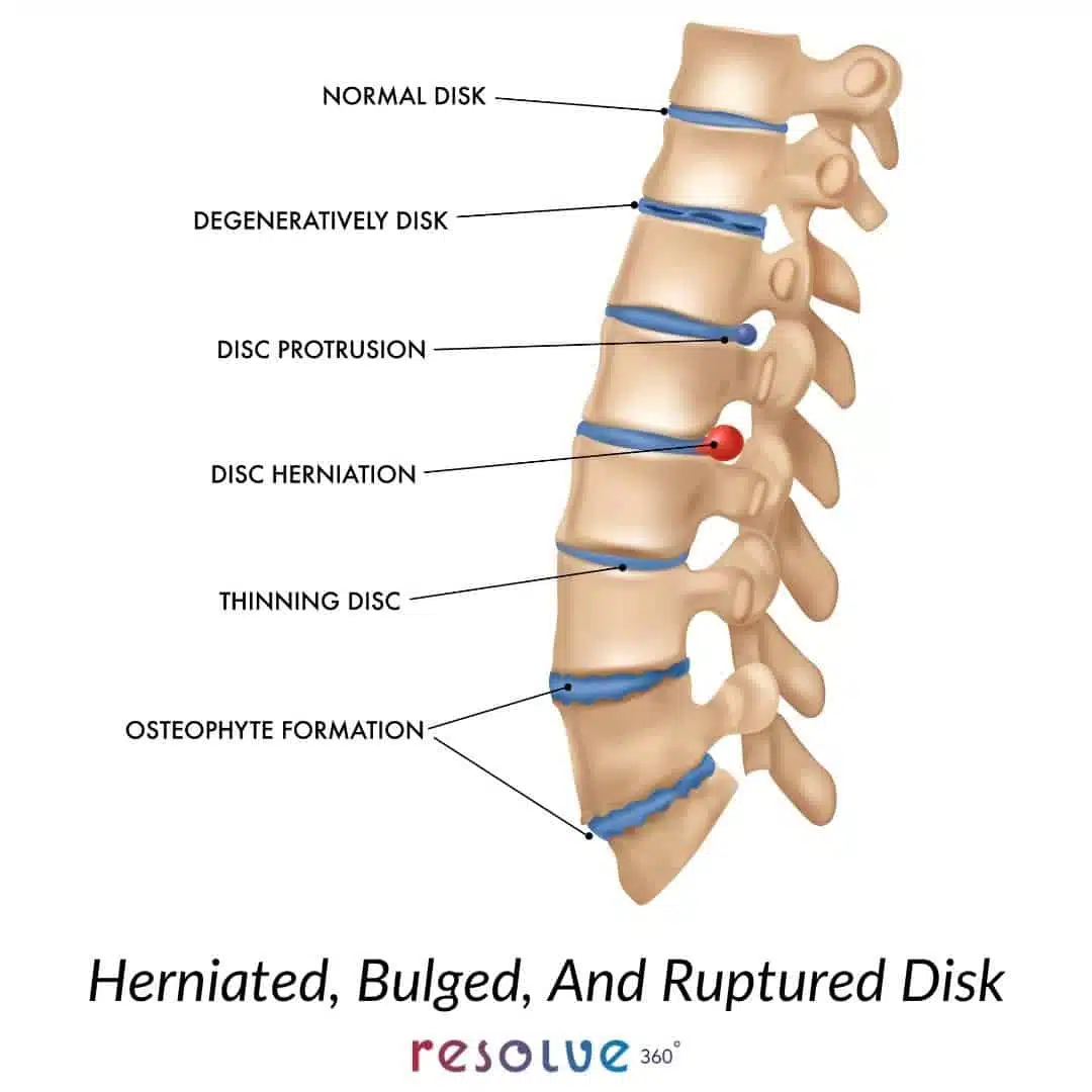 Herniated, Bulged & Rupture Disk