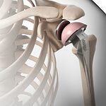 Shoulder Replacement Surgery